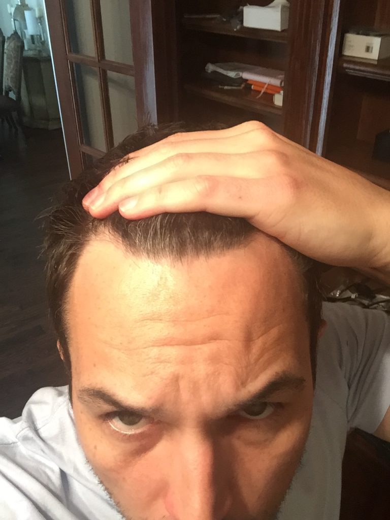 Finasteride worked great to restore my hair line but the depression it caused was the scariest side effect.