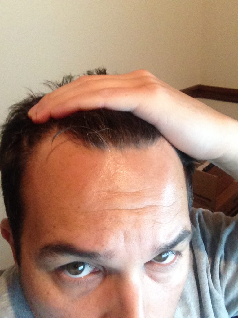 Me at the start of male pattern baldness with the front of my hairline starting to show noticeable thinning.