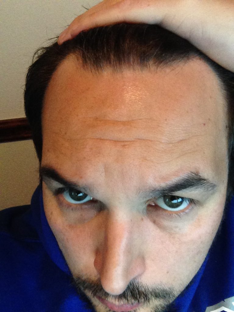 Me 2 months into rapid hair loss from male pattern baldness with my hairline increasingly receding and thinning.