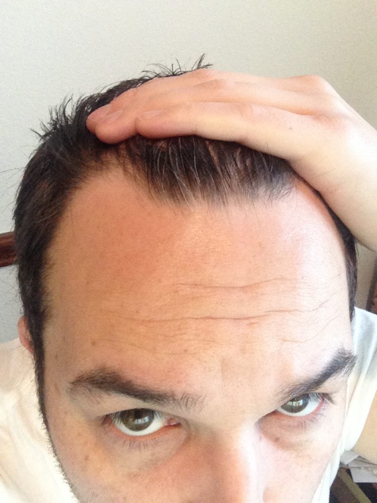 I started taking Finasteride as part of a hair loss treatment to stop a rapidly thinning and receding hairline.